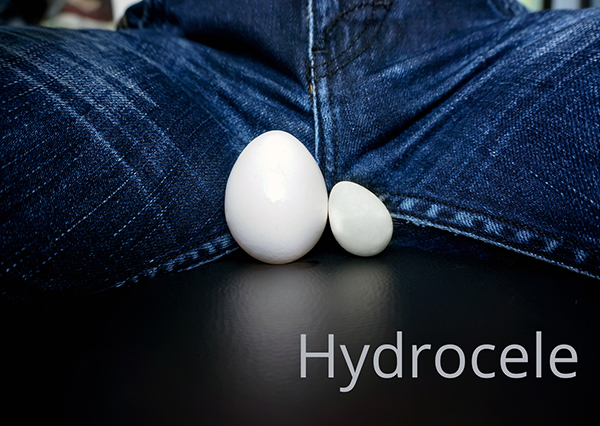 How to Know if You Have Hydrocele