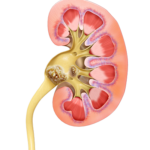 Dr. Dhir’s 4 Tips for Kidney Stone Prevention