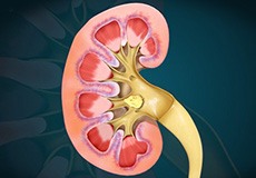 Kidney Stones - What are They?
