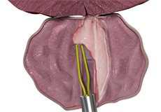 Transurethral Resection of Prostate (TURP)