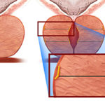 Why I Prefer the UroLift System for Enlarged Prostate (BPH)